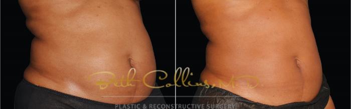 Before & After CoolSculpting® Case 165 Right Oblique View in Guilford, CT