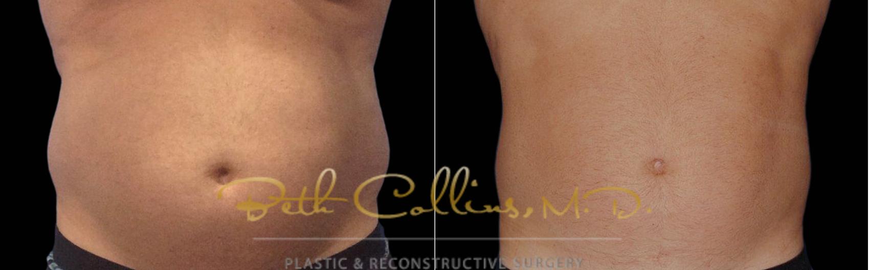 Before & After CoolSculpting® Case 166 Front View in Guilford, CT