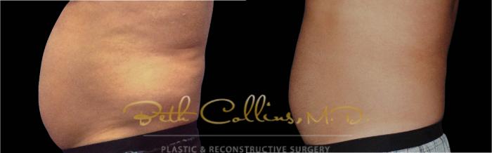 Before & After CoolSculpting® Case 166 Left Side View in Guilford, CT
