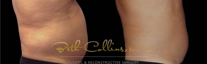 Before & After CoolSculpting® Case 166 Right Side View in Guilford, CT
