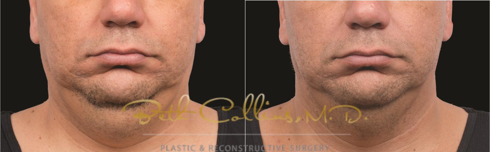 Before & After CoolSculpting® Case 167 Front View in Guilford, CT