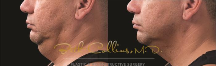 Before & After CoolSculpting® Case 167 Left Side View in Guilford, CT