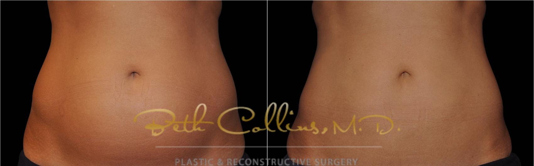 Before & After CoolSculpting® Case 168 Front View in Guilford, CT