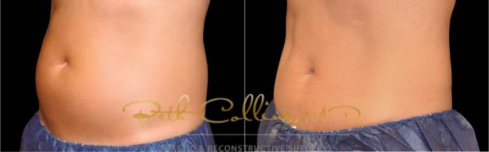 Before & After CoolSculpting® Case 169 Right Oblique View in Guilford, CT