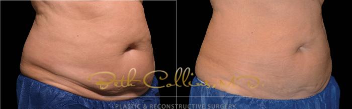 Before & After CoolSculpting® Case 170 Left Oblique View in Guilford, CT