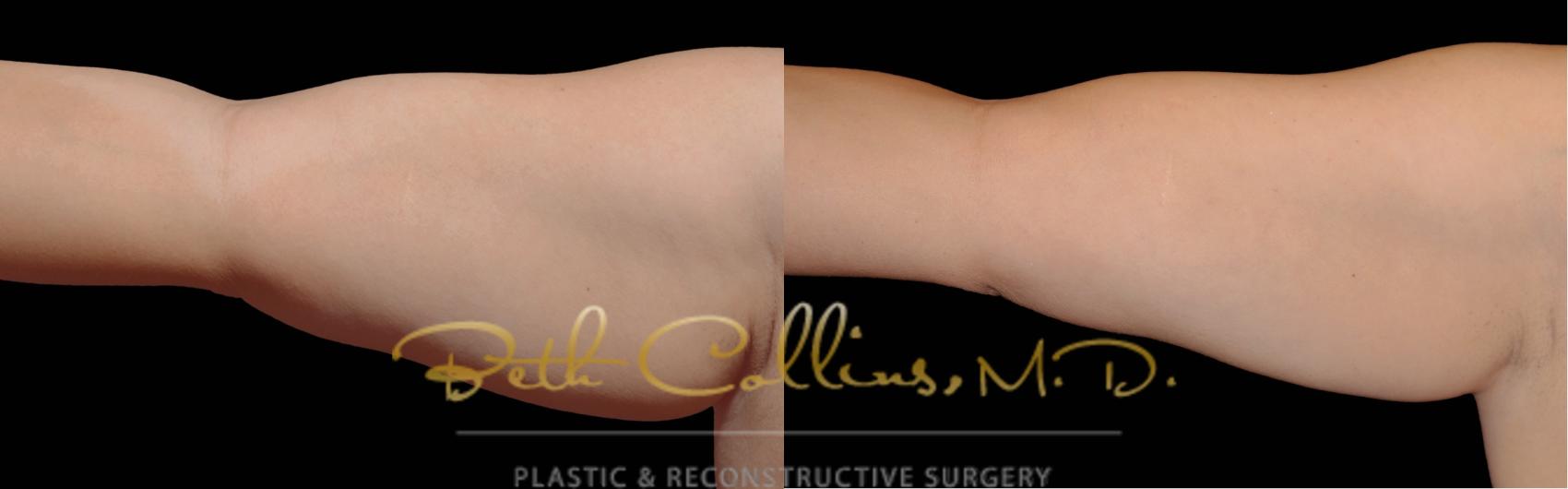 Before & After CoolSculpting® Case 171 Front View in Guilford, CT