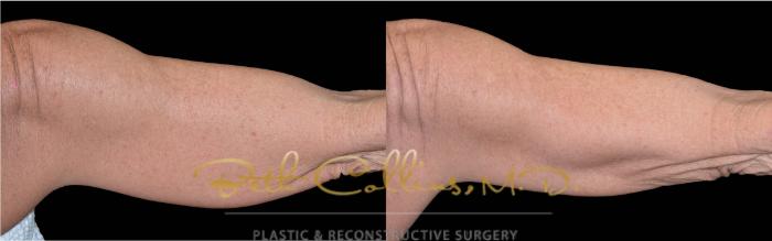 Before & After CoolSculpting® Case 172 Back View in Guilford, CT