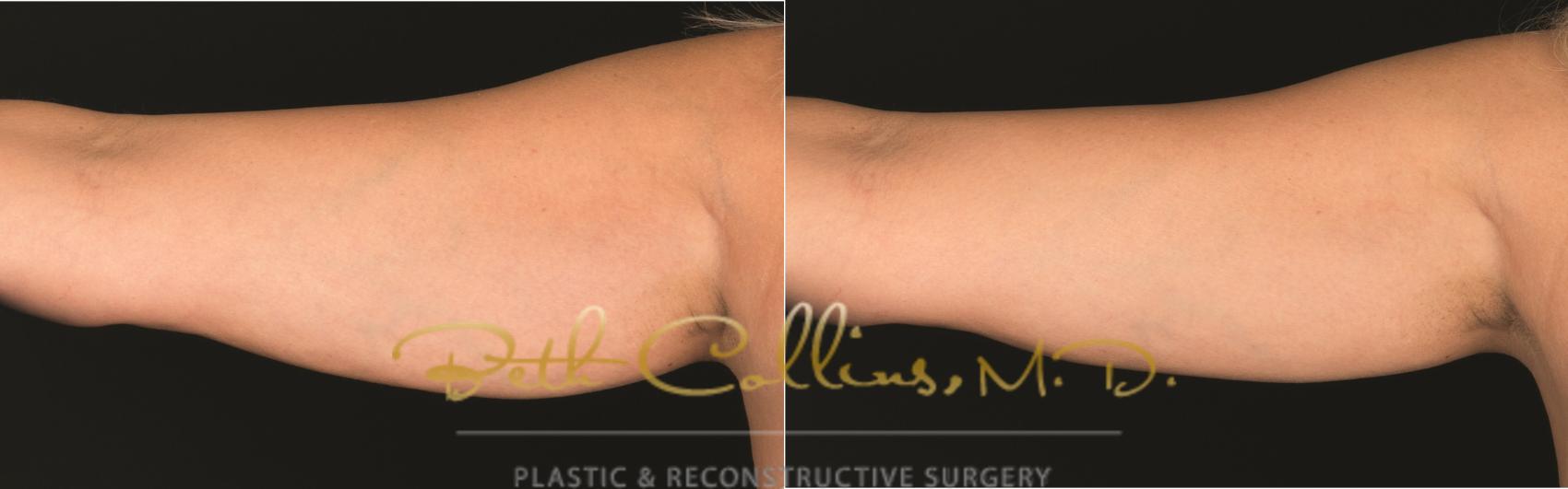 Before & After CoolSculpting® Case 173 Back View in Guilford, CT