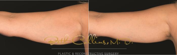 Before & After CoolSculpting® Case 173 Back View in Guilford, CT