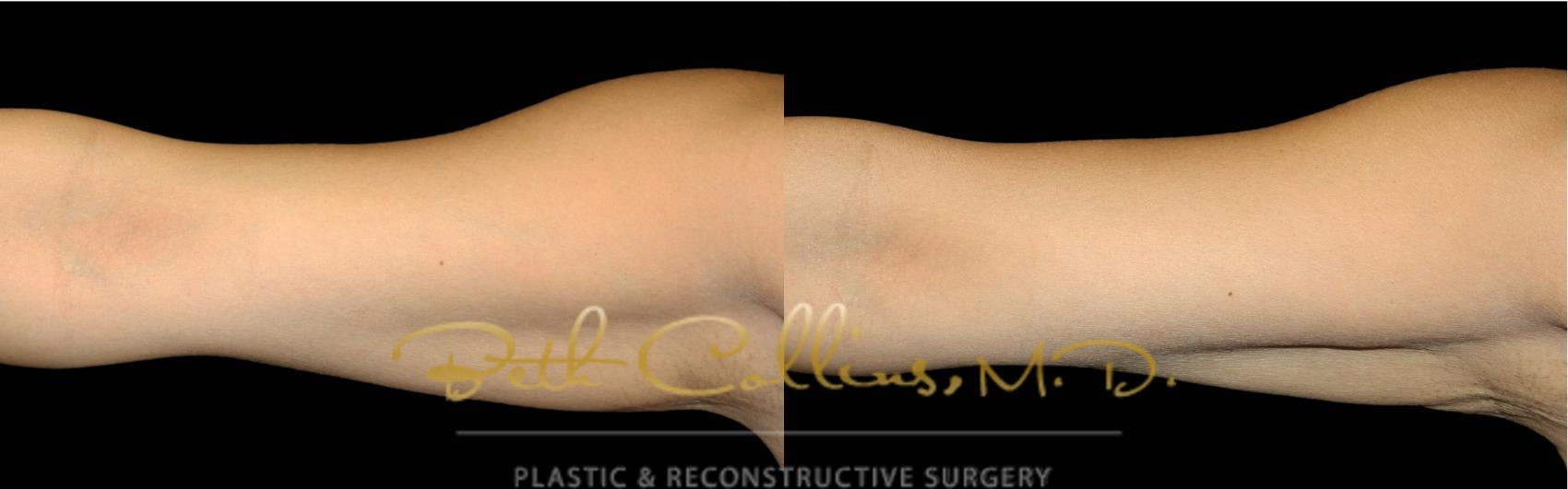 Before & After CoolSculpting® Case 174 Front View in Guilford, CT