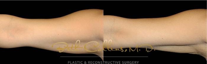 Before & After CoolSculpting® Case 174 Front View in Guilford, CT