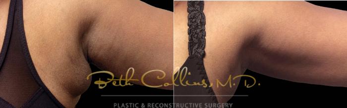 Before & After CoolSculpting® Case 175 Front View in Guilford, CT
