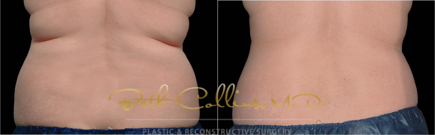 Before & After CoolSculpting® Case 176 Back View in Guilford, CT