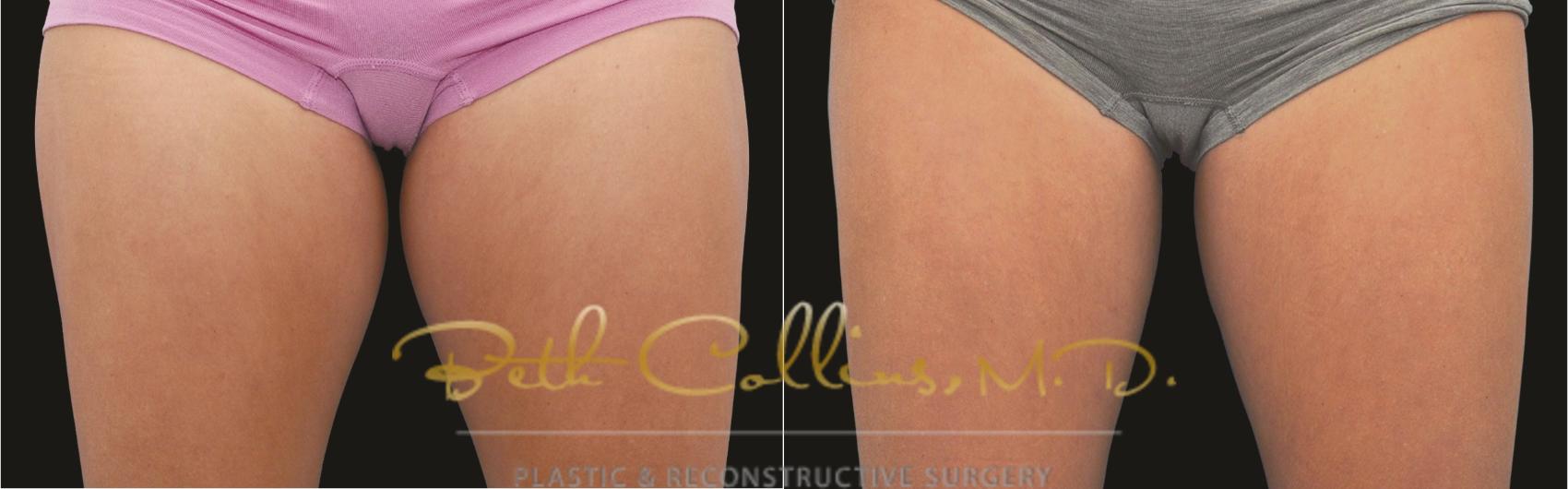 Before & After CoolSculpting® Case 177 Front View in Guilford, CT