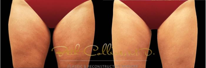 Before & After CoolSculpting® Case 178 Front View in Guilford, CT