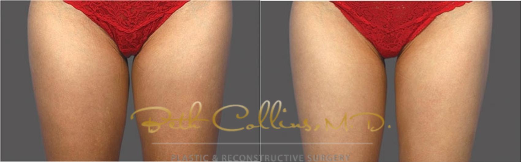 Before & After CoolSculpting® Case 179 Front View in Guilford, CT