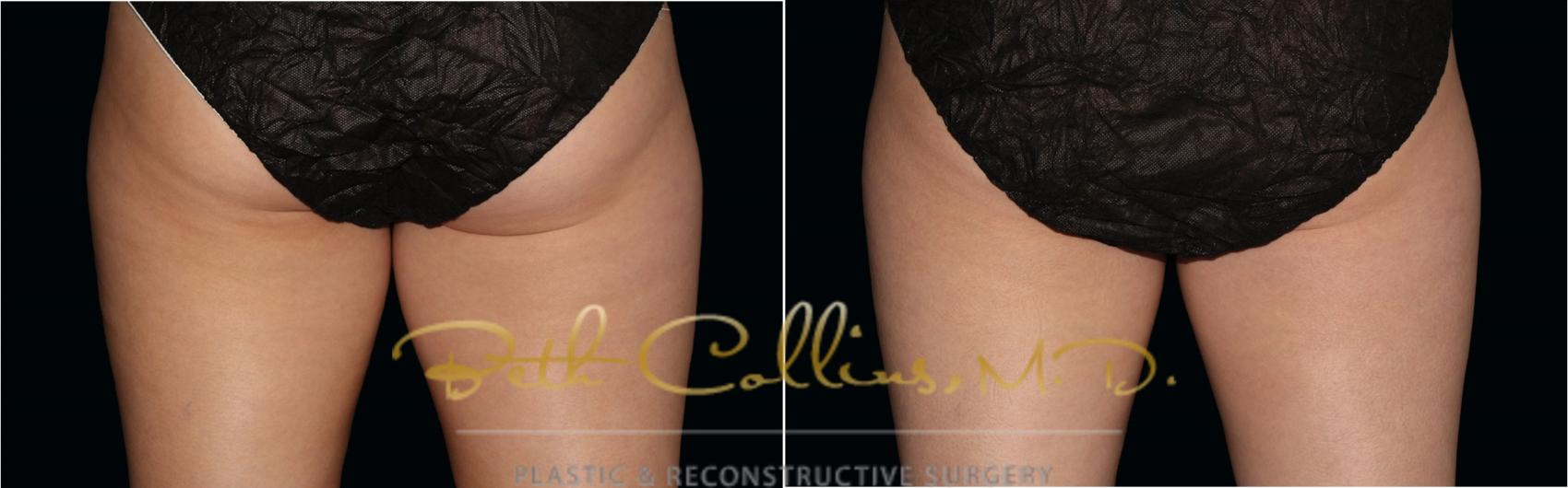 Before & After CoolSculpting® Case 180 Back View in Guilford, CT