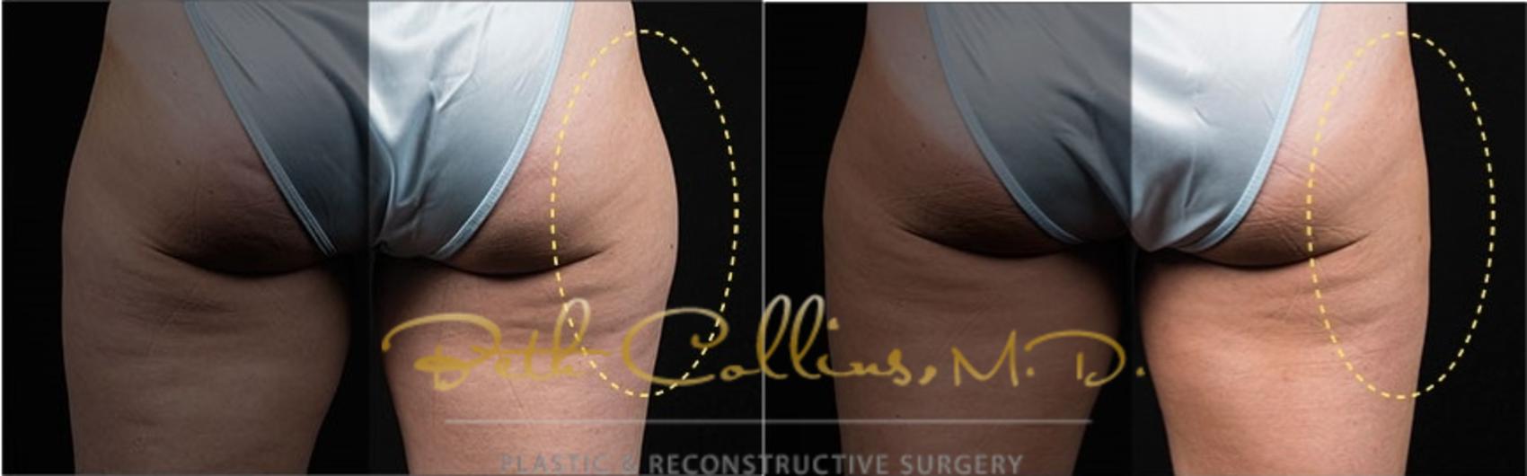 Before & After CoolSculpting® Case 181 Back View in Guilford, CT