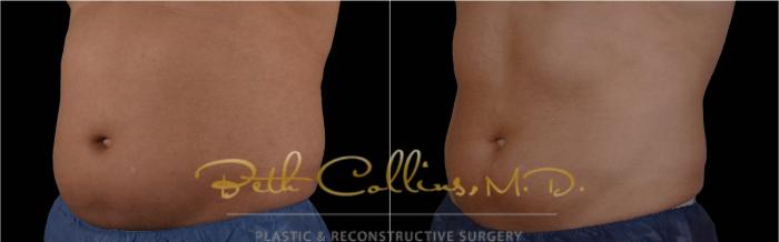 Before & After CoolSculpting® Case 182 Right Oblique View in Guilford, CT