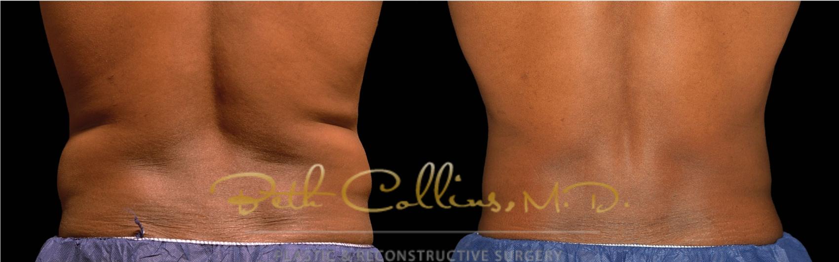 Before & After CoolSculpting® Case 183 Back View in Guilford, CT