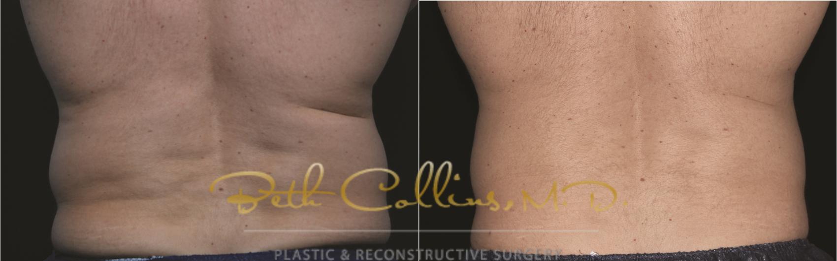 Before & After CoolSculpting® Case 184 Back View in Guilford, CT