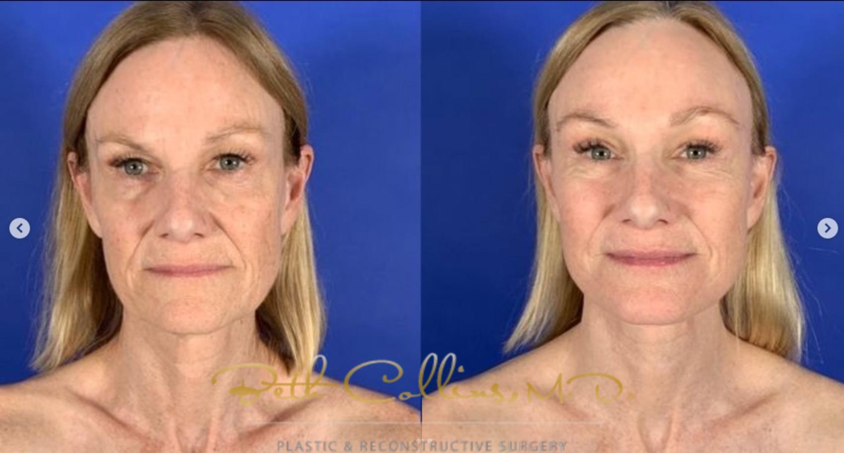 Before & After Facelift Case 261 Front View in Guilford, CT