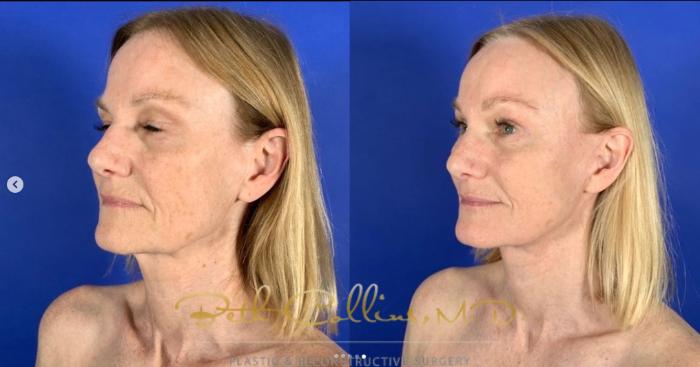 Before & After Deep Plane Facelift Case 261 Left Oblique View in Guilford, CT