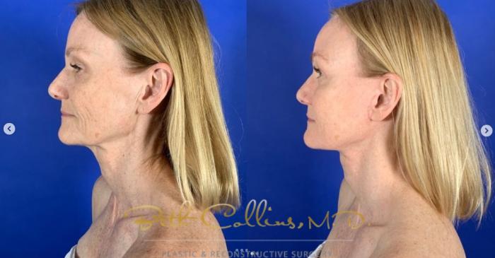 Before & After Facelift Case 261 Left Side View in Guilford, CT