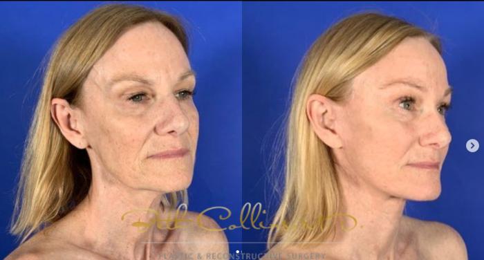 Before & After Laser Procedures Case 261 Right Oblique View in Guilford, CT