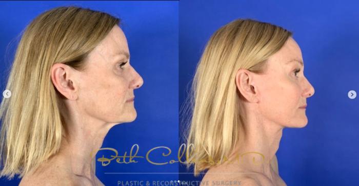 Before & After Deep Plane Facelift Case 261 Right Side View in Guilford, CT