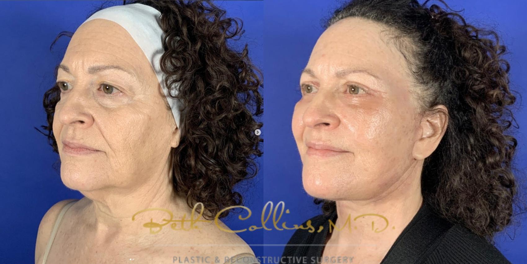 Before & After Deep Plane Facelift Case 262 Right Oblique View in Guilford, CT