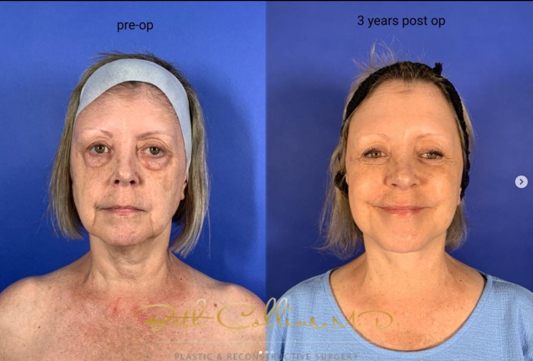 Before & After Neck Lift Case 267 Front - 3 Years After View in Guilford, CT