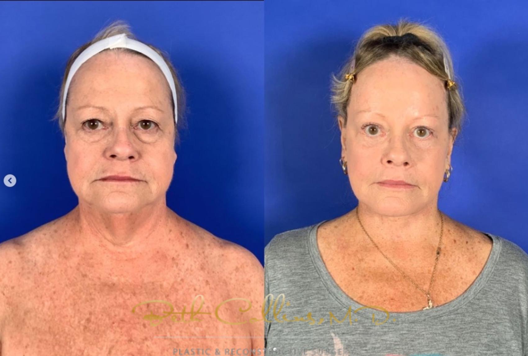 Before & After Laser Procedures Case 267 Front View in Guilford, CT