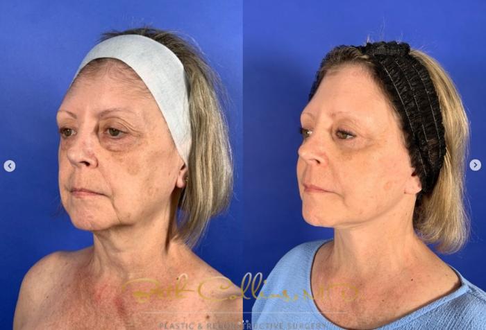 Before & After Facelift Case 267 Left Oblique - 3 Years After View in Guilford, CT