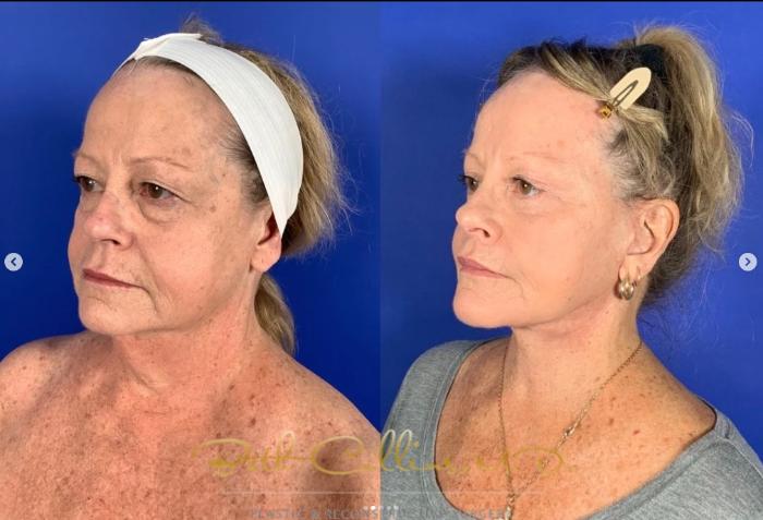 Before & After Laser Procedures Case 267 Left Oblique View in Guilford, CT