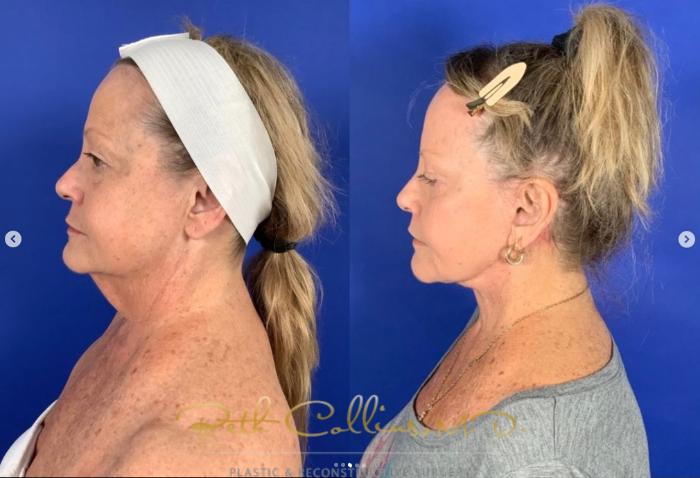 Before & After Neck Lift Case 267 Left Side View in Guilford, CT