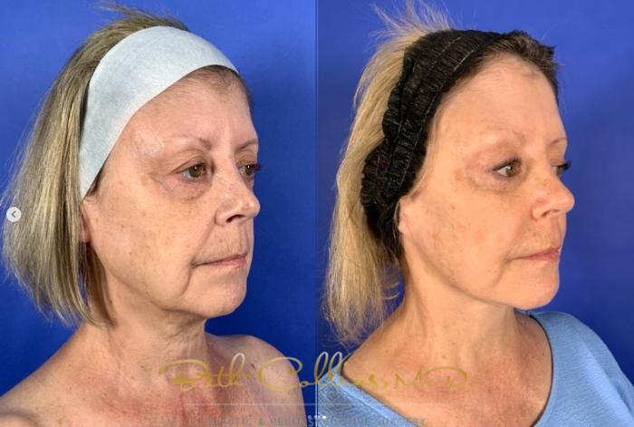 Before & After Deep Plane Facelift Case 267 Right Oblique - 3 Years After View in Guilford, CT