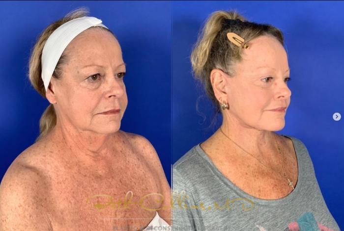 Before & After Deep Plane Facelift Case 267 Right Oblique View in Guilford, CT