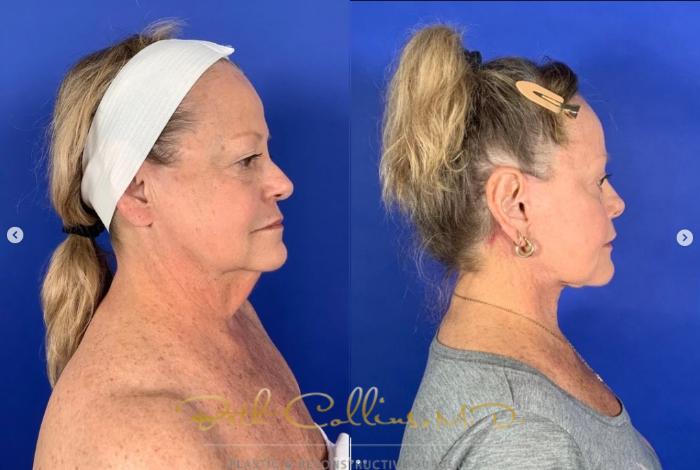 Before & After Laser Procedures Case 267 Right Side View in Guilford, CT