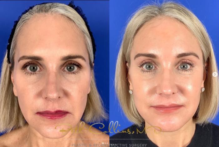 Before & After Neck Lift Case 270 Front View in Guilford, CT