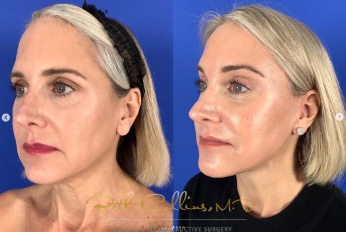 Before & After Deep Plane Facelift Case 270 Left Oblique View in Guilford, CT