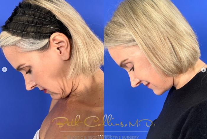 Before & After Neck Liposuction Case 270 Left Side - Head Bent View in Guilford, CT