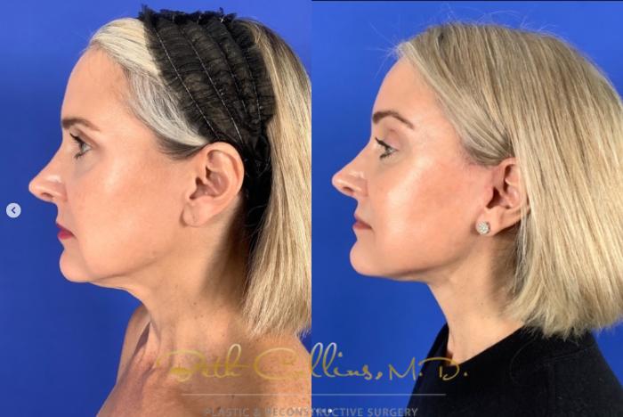 Before & After Deep Plane Facelift Case 270 Left Side View in Guilford, CT