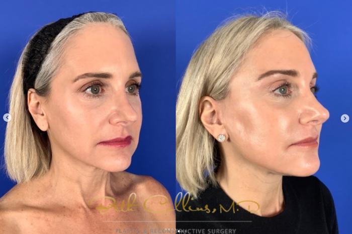 Before & After Deep Plane Facelift Case 270 Right Oblique View in Guilford, CT