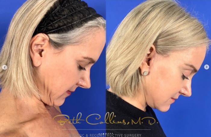 Before & After Neck Lift Case 270 Right Side - Head Bent View in Guilford, CT