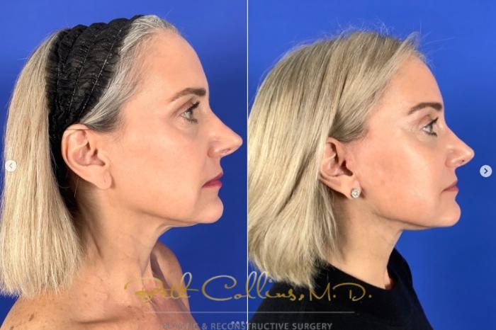 Before & After Neck Lift Case 270 Right Side View in Guilford, CT