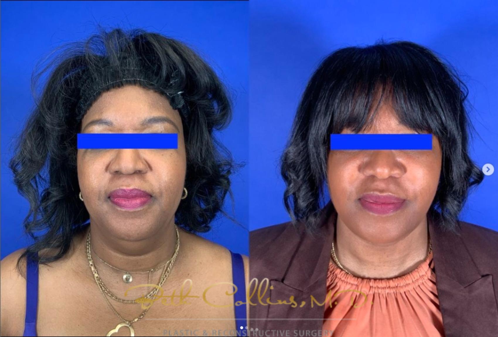 Before & After Deep Plane Facelift Case 273 Front View in Guilford, CT