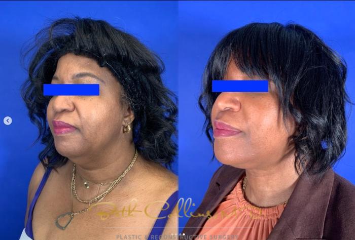 Before & After Neck Lift Case 273 Left Oblique View in Guilford, CT