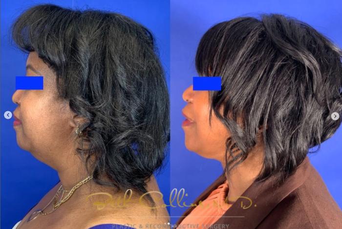 Before & After Neck Lift Case 273 Left Side View in Guilford, CT