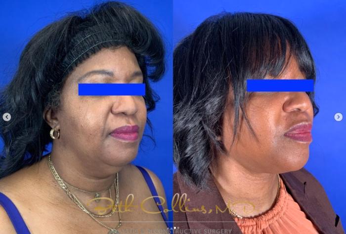 Before & After Neck Lift Case 273 Right Oblique View in Guilford, CT